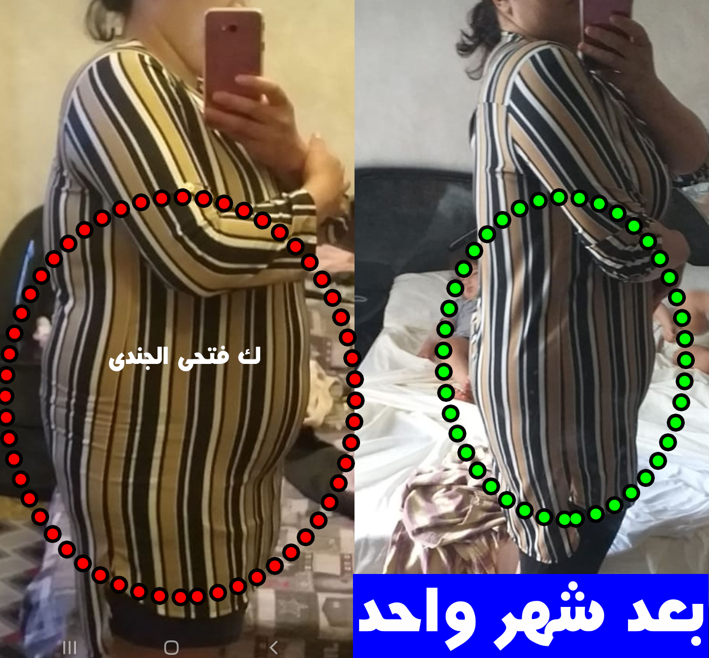 ماليكة — نتيجة قبل وبعد بعد ٣ ولادات قيصرية