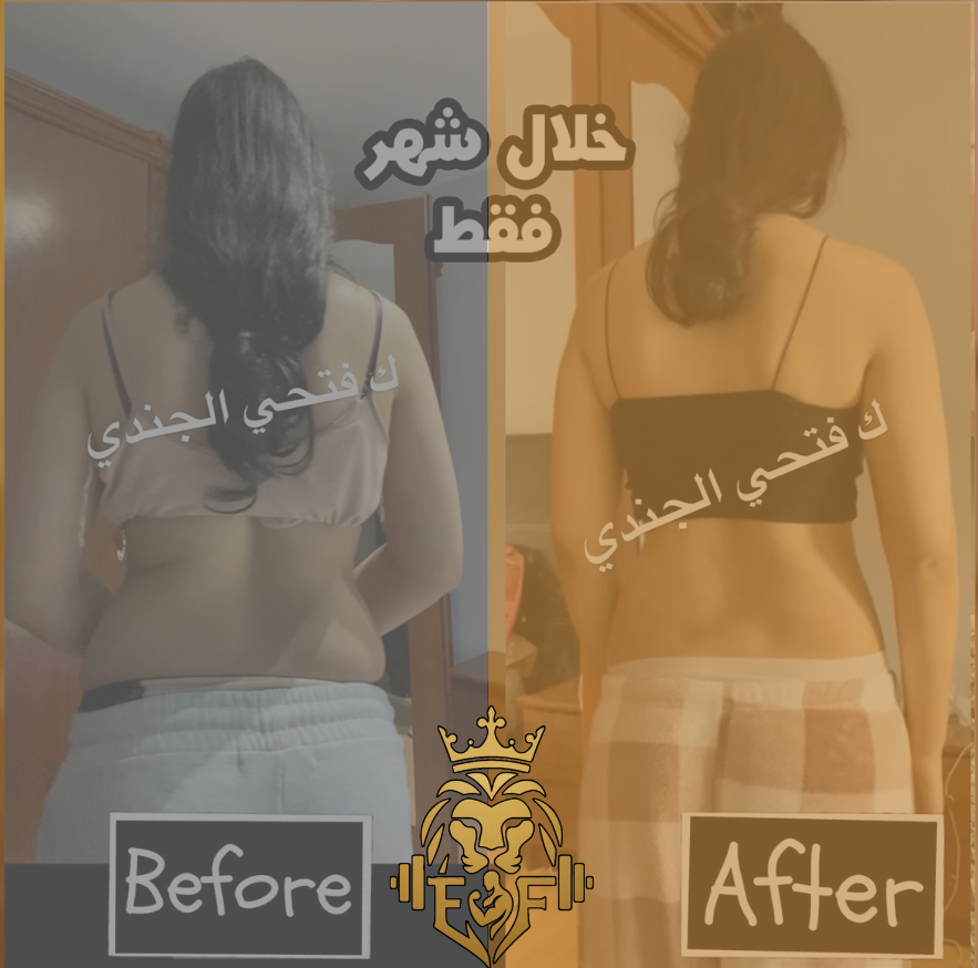 شيماء — نتيجة قبل وبعد التخلص من دهون البطن والجوانب